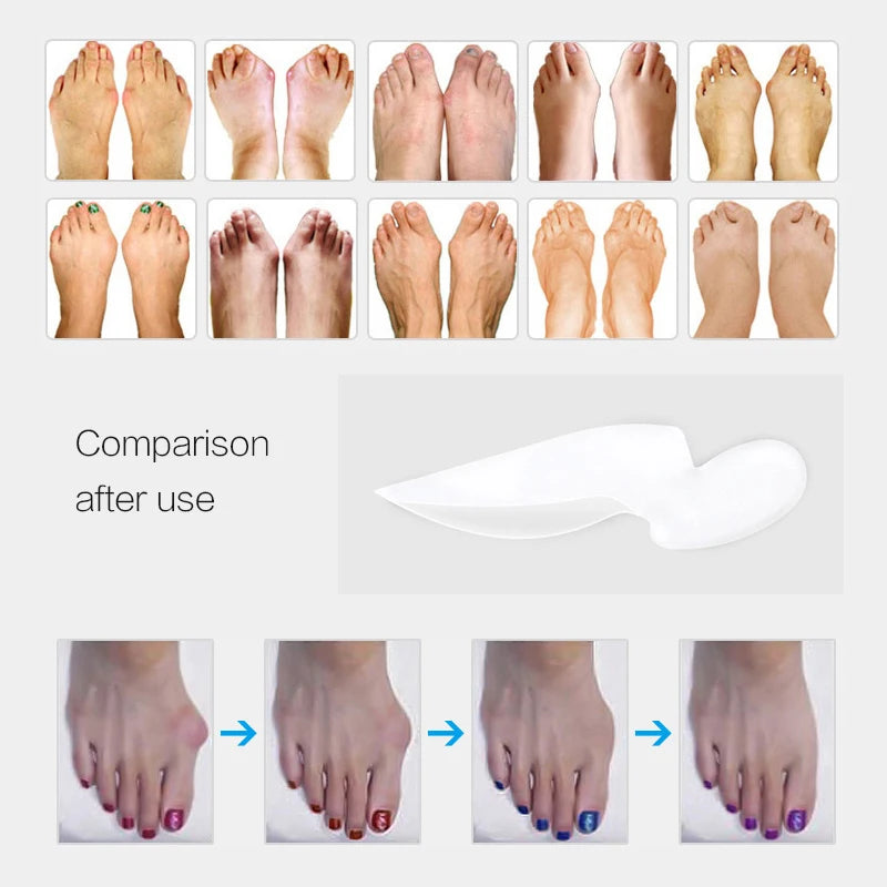 1pair Hallux Valgus Broadhurst Pad Remedical Bone Thumb Silica Gel Daily Use Silicone Foot Care Sets Toe Bunion Protector