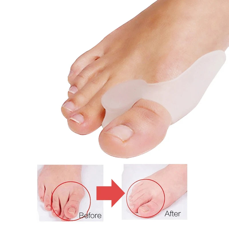 1pair Hallux Valgus Broadhurst Pad Remedical Bone Thumb Silica Gel Daily Use Silicone Foot Care Sets Toe Bunion Protector