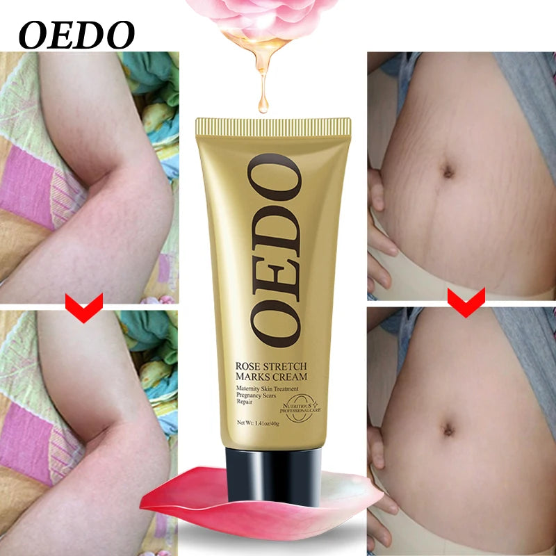 OEDO Stretch Mark Cream Remove Stretch Marks Skin Repair For Pregnant Women Remove Wrinkles Firm Skin Body Lotion Body Care