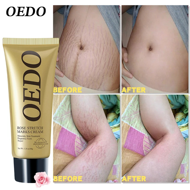 OEDO Stretch Mark Cream Remove Stretch Marks Skin Repair For Pregnant Women Remove Wrinkles Firm Skin Body Lotion Body Care